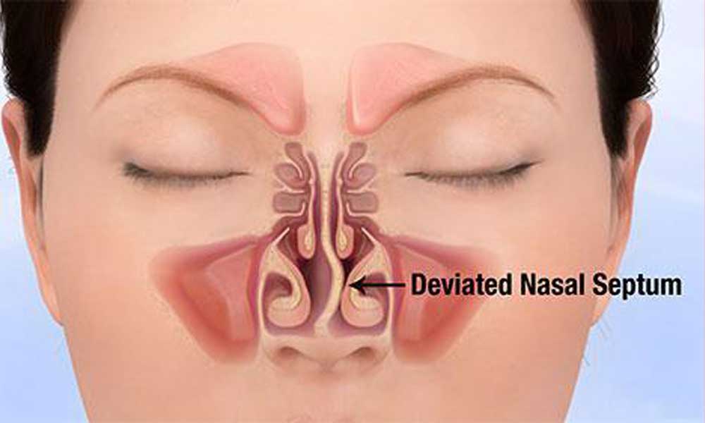 Deviated Septum Deviated Septum the Ultimate Guide to Treatments
