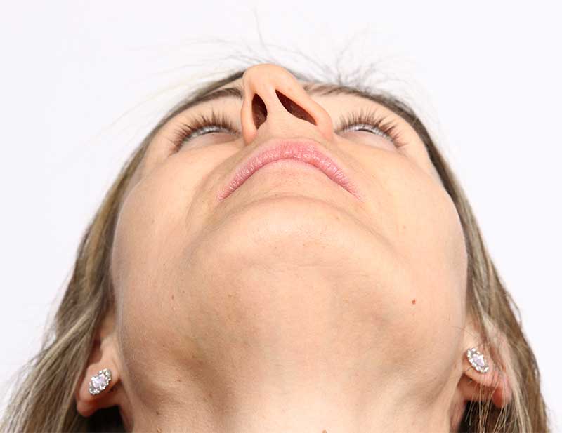 Deviated Septum Surgery Deviated Septum Surgery in Scottsdale, AZ