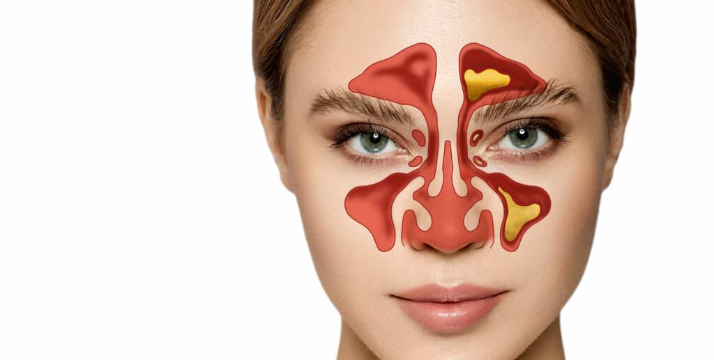 Chronic Sinusitis Millimeter Changes in your Nose And Their Impact On Sinuses